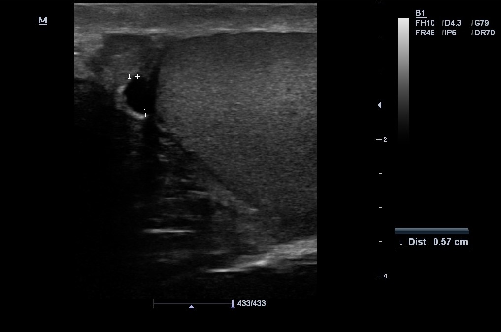 Chronic appendicitis with coexistent hydrocele and varicocele | Image ...