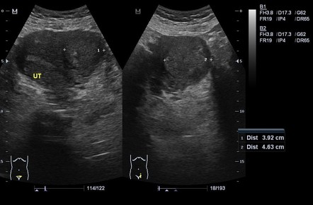 Leiomyoma of uterus | Radiology Case | Radiopaedia.org