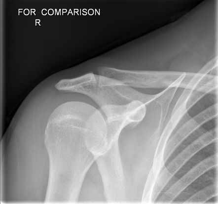 Acromioclavicular Injury - Rockwood Type V 