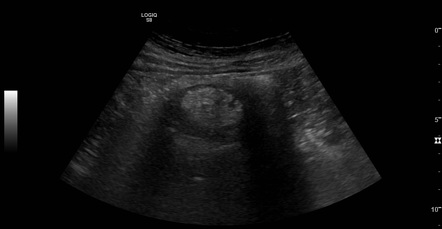 Colonic intussusception - colonic lipoma | Radiology Case | Radiopaedia.org