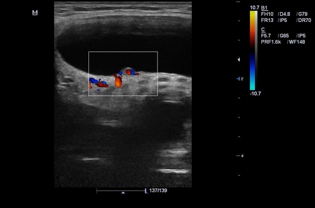 thyroid cyst ultrasound