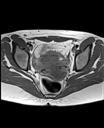 Ovarian endometriomas (MRI signs) | Image | Radiopaedia.org