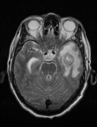 Dual rim sign (brain abscess) | Radiology Reference Article ...