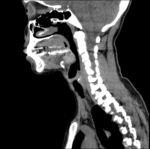 Lingual thyroid | Image | Radiopaedia.org