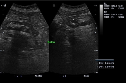 Peptic ulcer | Image | Radiopaedia.org