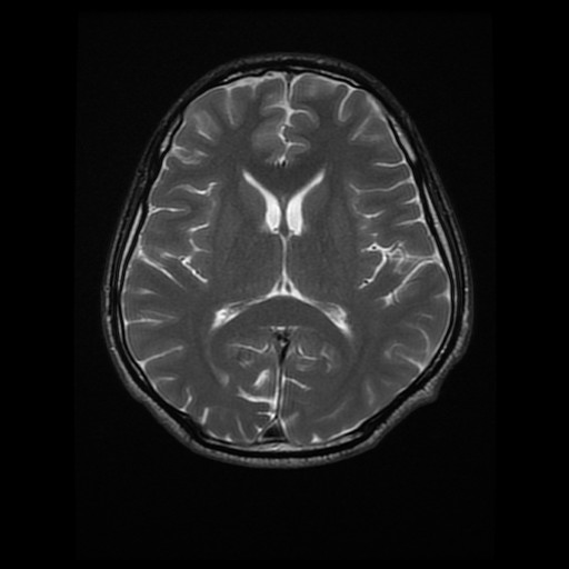 Wilson disease | Image | Radiopaedia.org