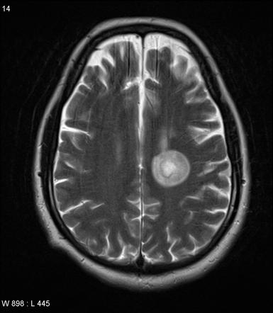 Balo Concentric Sclerosis Radiology Reference Article Radiopaedia Org