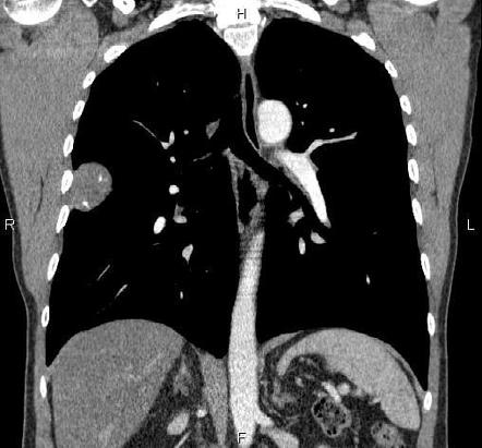 Solitary fibrous tumor - pleura | Image | Radiopaedia.org