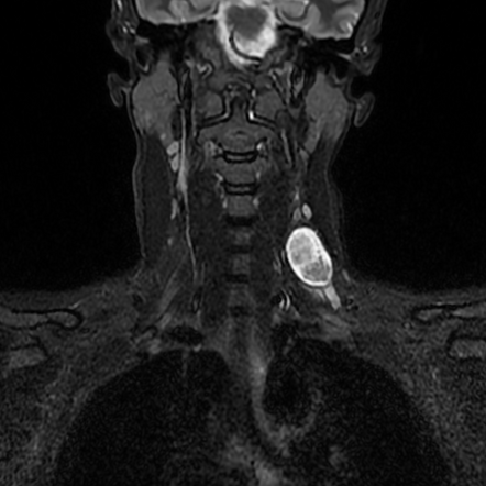 C5 nerve sheath tumour | Radiology Case | Radiopaedia.org