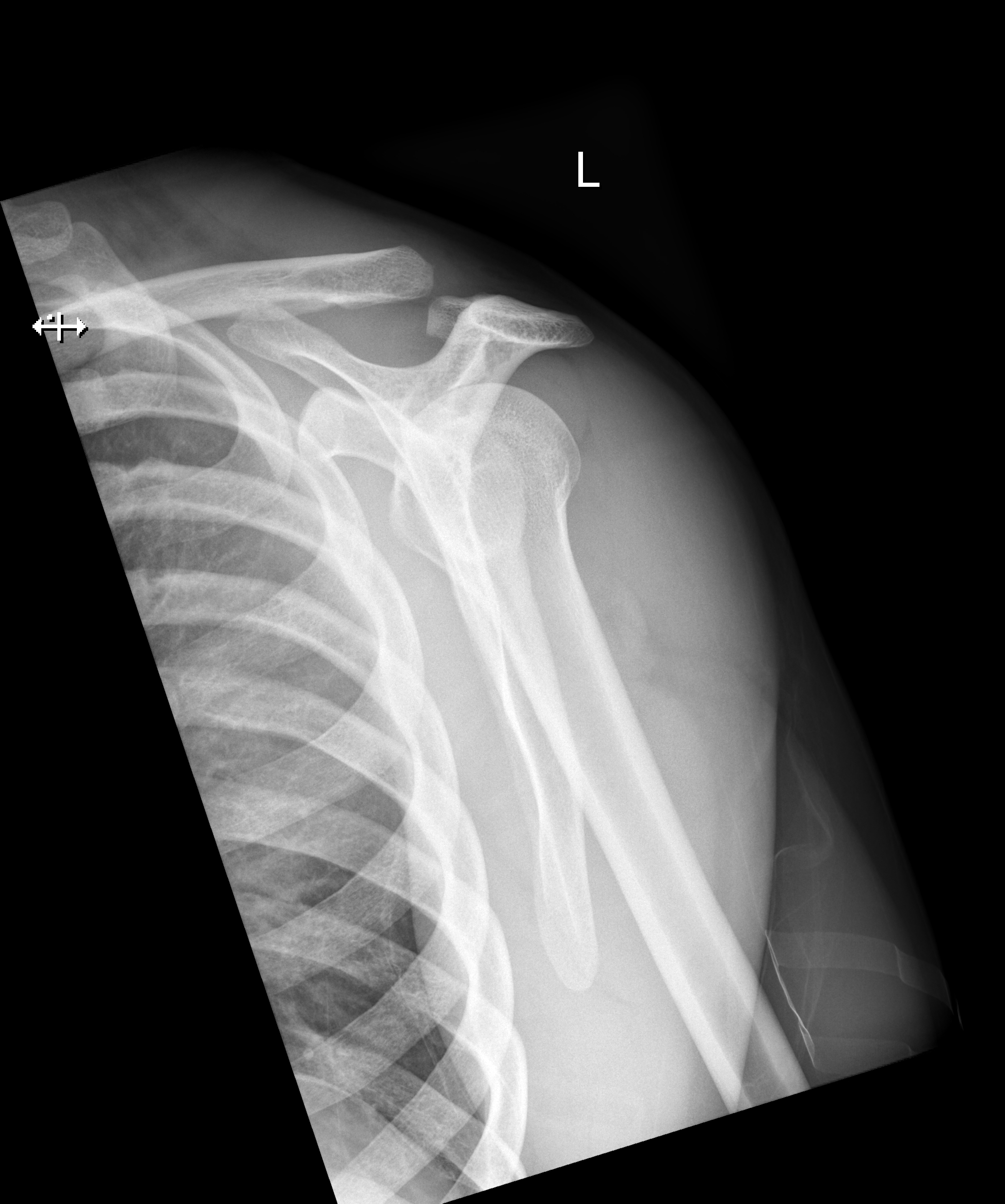 Acromioclavicular Injury Rockwood Type V Image Radiopaedia Org