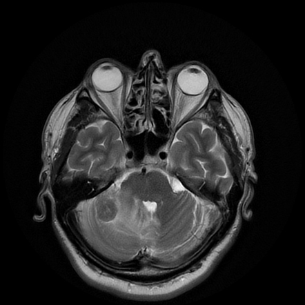 Cerebellar metastasis of pulmonary adenocarcinoma, cavernous venous ...