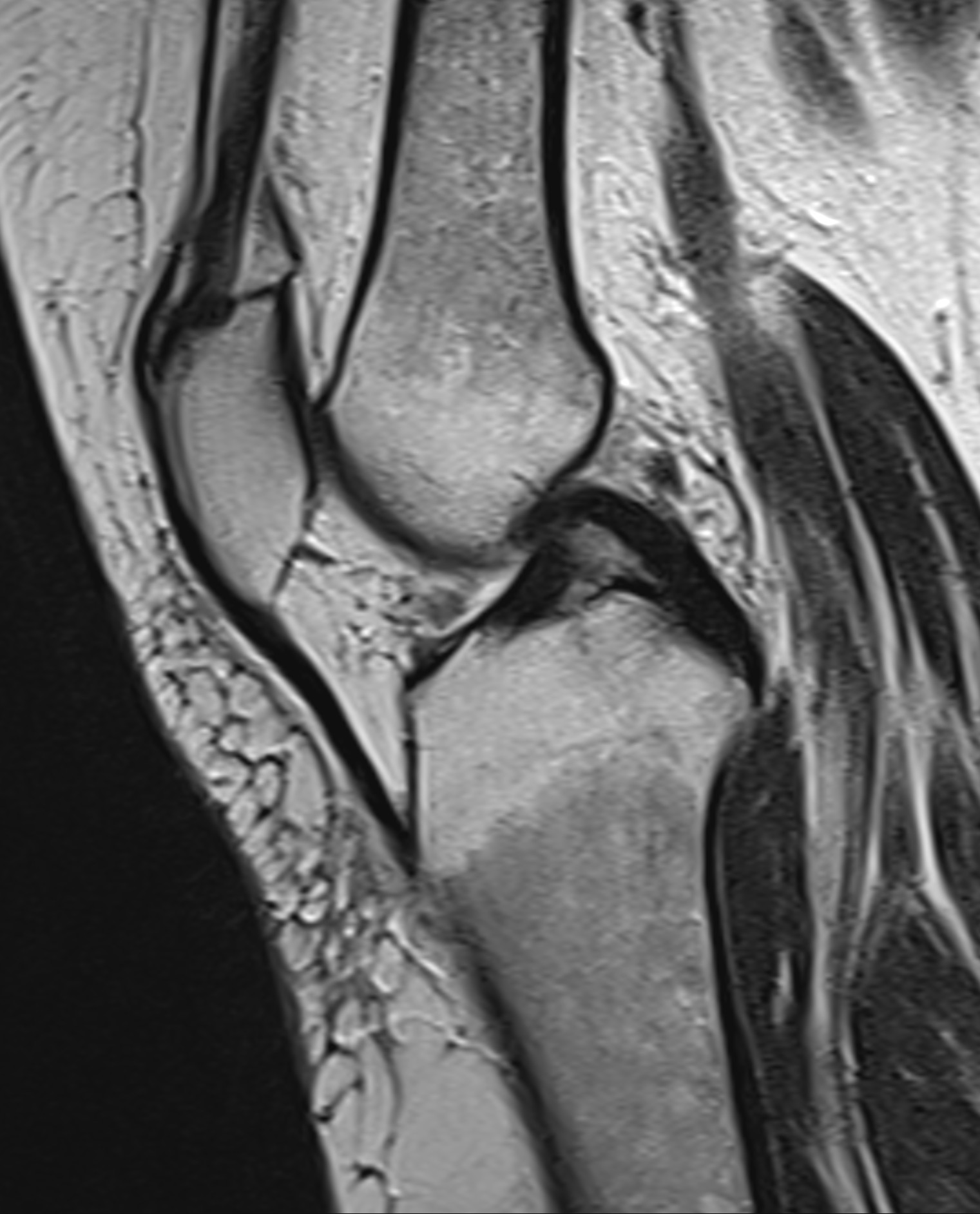 Normal posterior meniscofemoral ligament - ligament of Wrisberg | Image ...