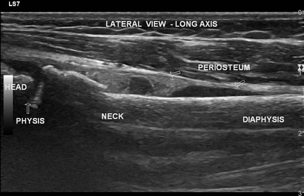 Proximal humerus fracture | Radiology Case | Radiopaedia.org