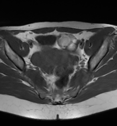 Ovarian dermoid cyst | Radiology Case | Radiopaedia.org