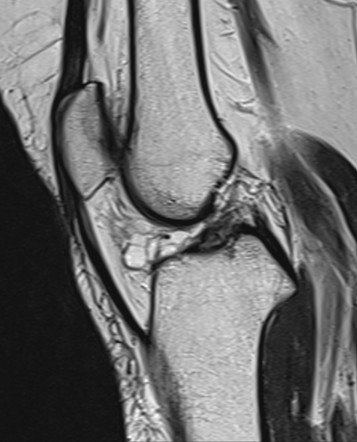 Hoffa fat pad ganglion cyst | Image | Radiopaedia.org