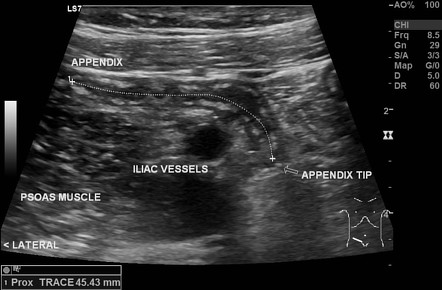 Acute Appendicitis | Radiology Reference Article | Radiopaedia.org