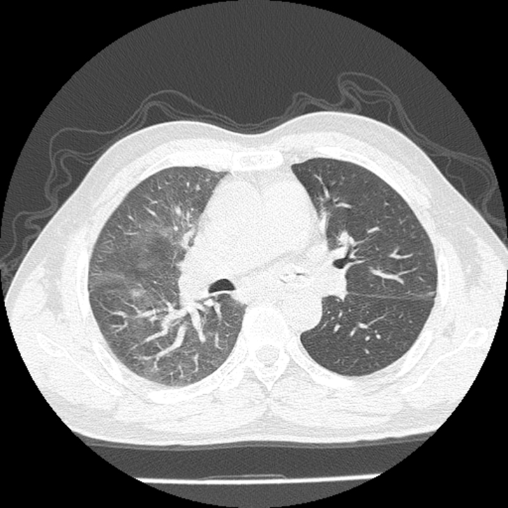 Airway Foreign Body In Adult Image 3873