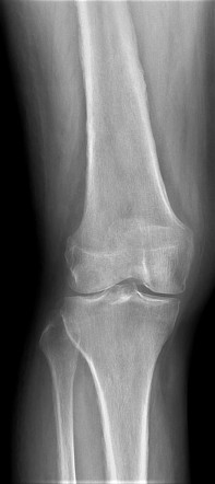 Solid periosteal reaction - hypertrophic osteoarthopathy | Image ...