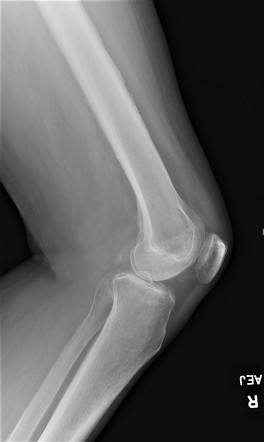 Solid periosteal reaction - hypertrophic osteoarthopathy | Image ...