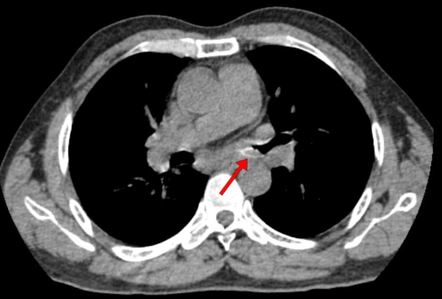 Airway foreign body in adult | Image | Radiopaedia.org