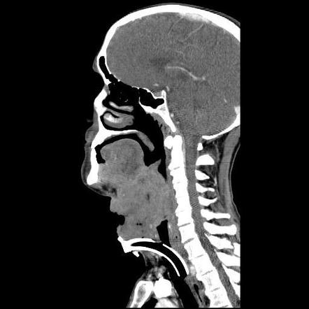 Squamous cell carcinoma of larynx with transglottic spread - T4 ...