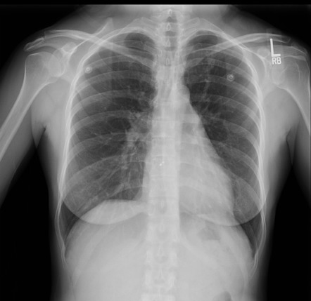 Atrial septal defect (ASD) closure device | Radiology Case ...