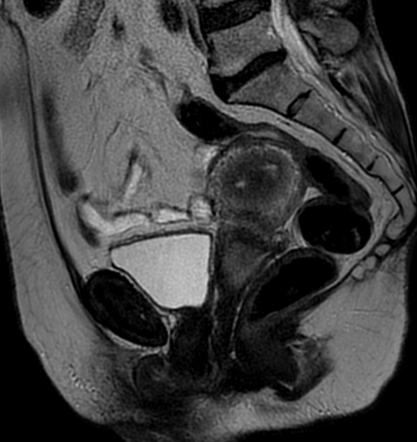 Squamous cell carcinoma of the cervix | Image | Radiopaedia.org