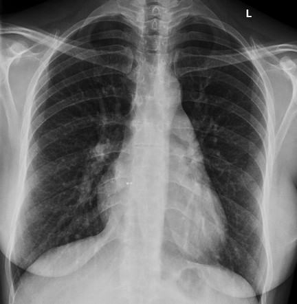 Atrial septal defect closure device | Radiology Case | Radiopaedia.org