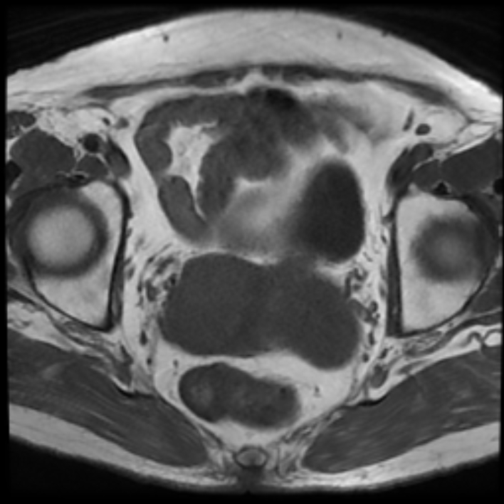 Squamous Cell Carcinoma Of The Cervix Image 