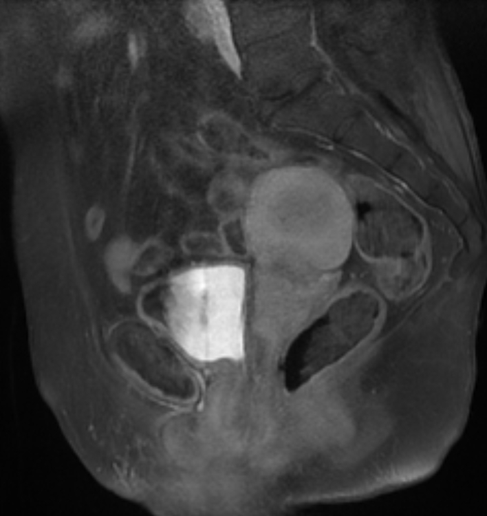 Squamous Cell Carcinoma Of The Cervix Image 