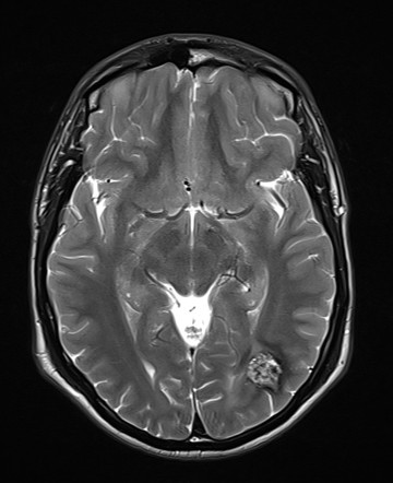 Cavernoma | Radiology Case | Radiopaedia.org