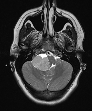 Choroid plexus papilloma extending into the cerebellopontine angle ...