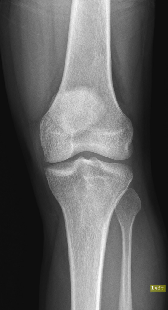 Maxillary Tuberosity Fracture