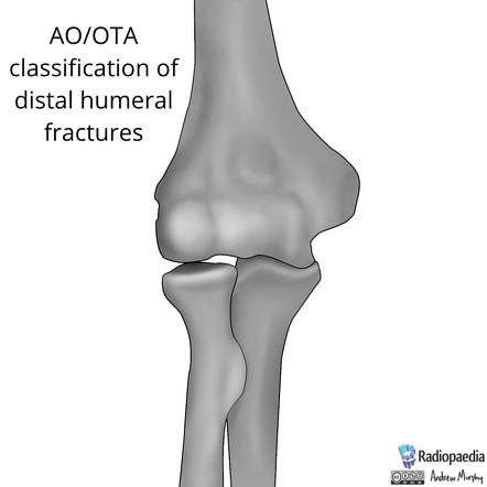 AO/OTA classification of distal humeral fractures, Radiology Case