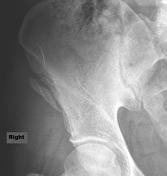 Anterior superior iliac spine avulsion injury | Radiology Reference ...