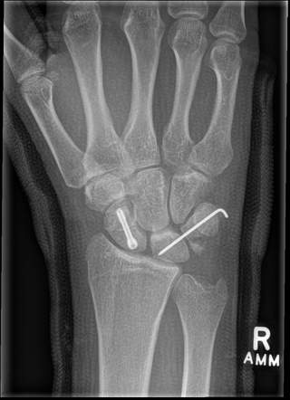 Perilunate dislocation | Radiology Reference Article | Radiopaedia.org