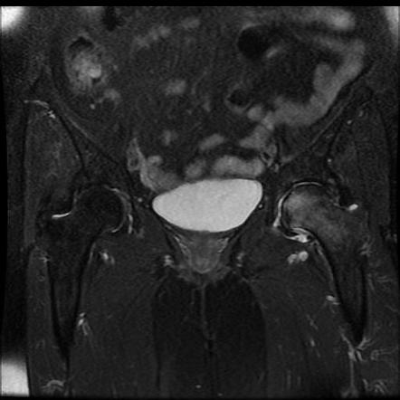 Osteonecrosis | Radiology Reference Article | Radiopaedia.org