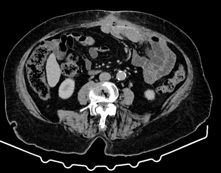 Enterocutaneous Fistula Ostomy