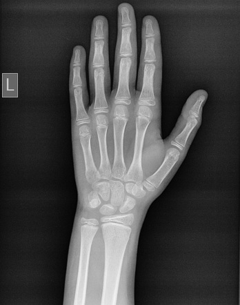 Torus fracture | Radiology Case | Radiopaedia.org