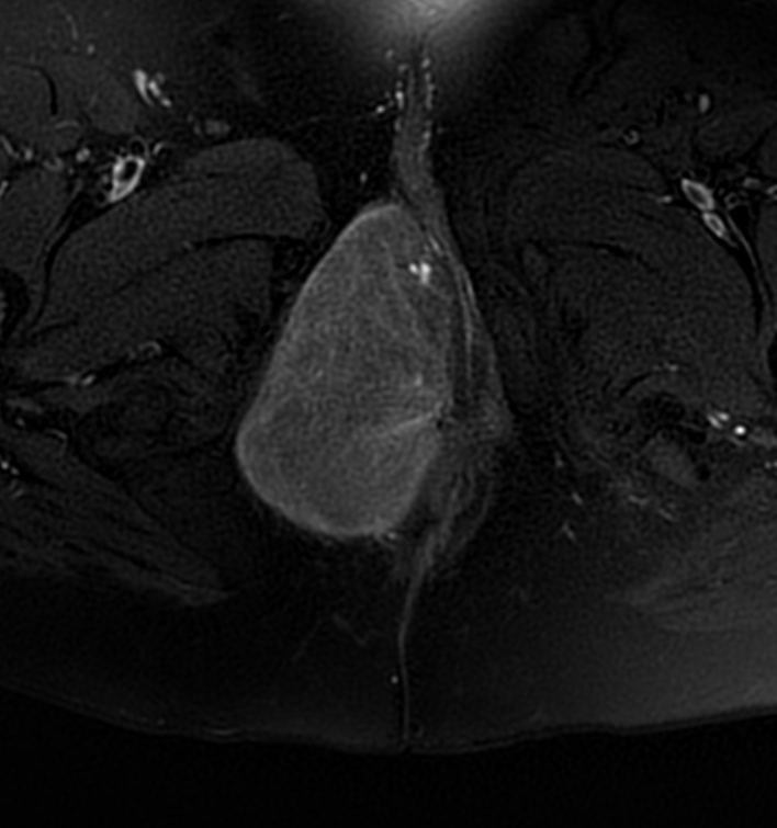 Perineal leiomyoma | Image | Radiopaedia.org