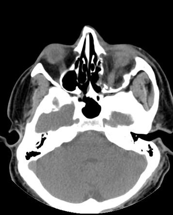 Inferior orbital blowout fracture | Image | Radiopaedia.org