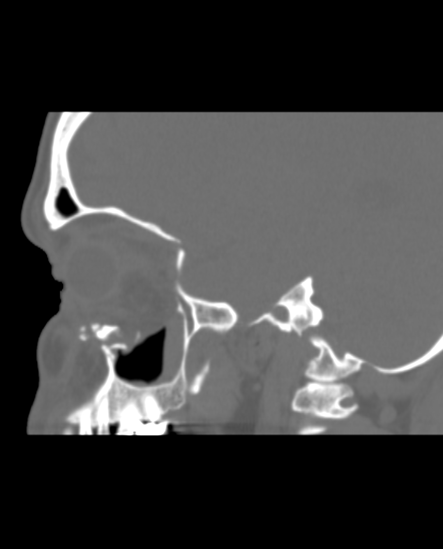 Inferior Orbital Blowout Fracture | Image | Radiopaedia.org