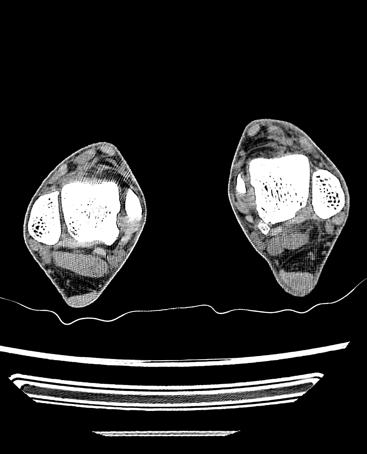 Insertional Achilles Tendinopathy And Calcific Enthesopathy | Image ...