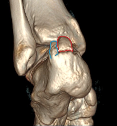 Enthesophyte Radiology Reference Article Radiopaedia Org   Annotated 3D Gallery 