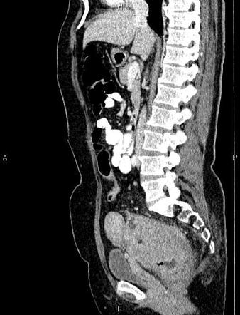 Rectal Cancer | Radiology Reference Article | Radiopaedia.org