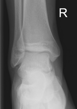 Os subfibulare | Radiology Case | Radiopaedia.org