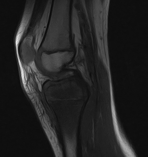 Brodie abscess Radiology Case Radiopaedia