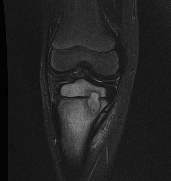 Brodie abscess Radiology Reference Article Radiopaedia