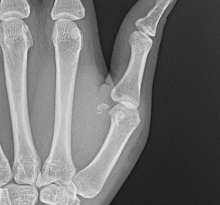 X Ray Left Thumb