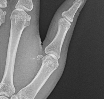 X Ray Left Thumb